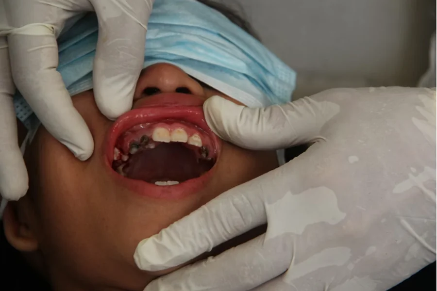 Mouth Restorations