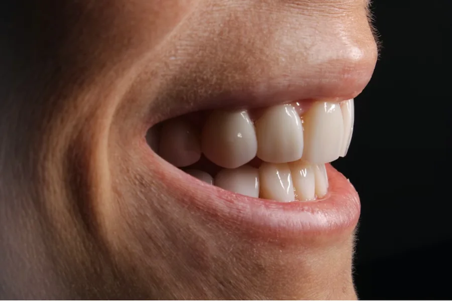 Mouth Restorations